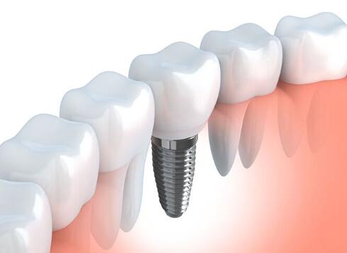 整個種植牙修復過程要多久-四川義齒廠家