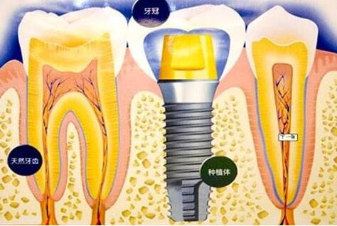 種植牙齒有什么壞處-義齒廠家