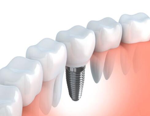 整個種植牙修復過程要多久-四川義齒廠家