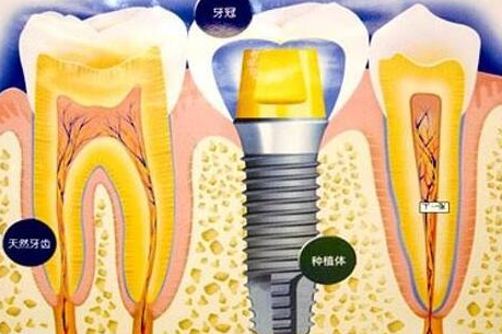 種植牙齒有什么壞處-義齒廠家