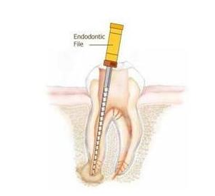 什么叫根管治療-四川義齒廠家