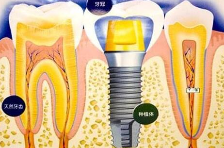 種植牙齒有什么壞處-義齒廠家