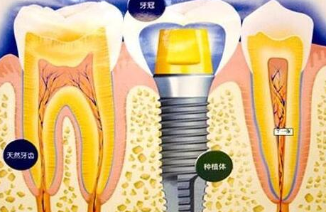 種植牙齒有什么壞處-義齒廠家