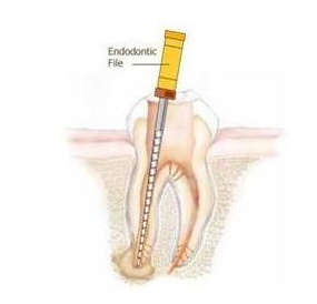 什么叫根管治療-四川義齒廠家