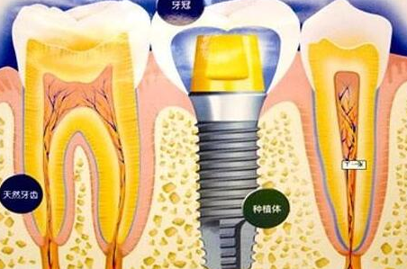 種植牙齒有什么壞處-義齒廠家