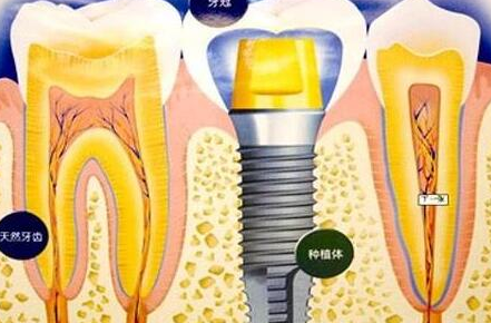 種植牙齒有什么壞處-義齒廠家