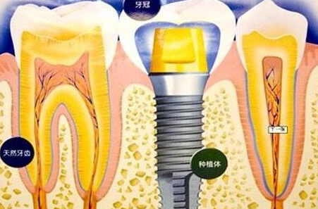 種植牙齒有什么壞處-義齒廠家