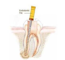 什么叫根管治療-四川義齒廠家