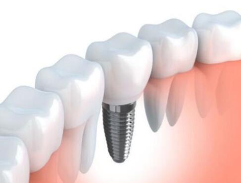 整個種植牙修復過程要多久-四川義齒廠家