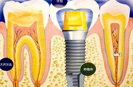 種植牙齒有什么壞處-義齒廠家