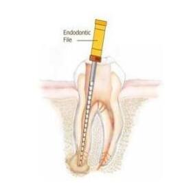 什么叫根管治療？ |  四川義齒廠家