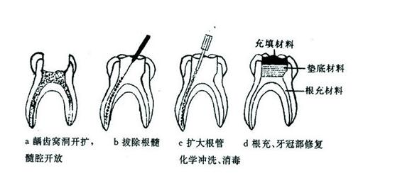 做根管治療大概要多久 | 成都義齒廠(chǎng)家